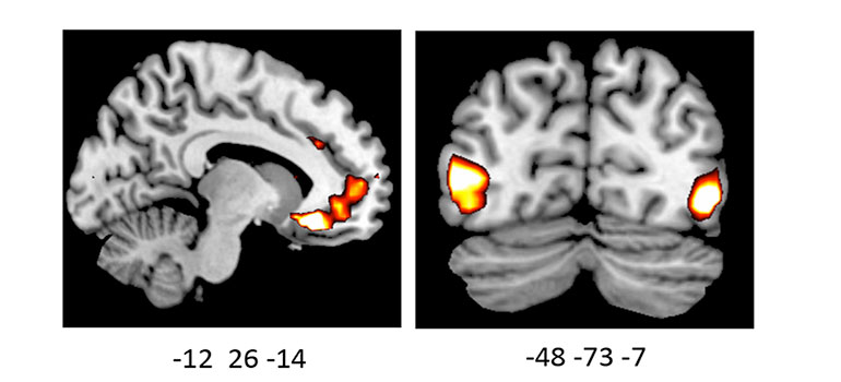 Image shows increased activity in the brains of ADRA2b deletion carriers.